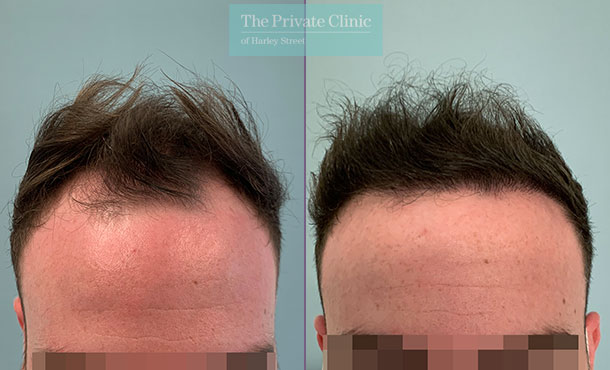 FUE Hair Transplant - 015FR