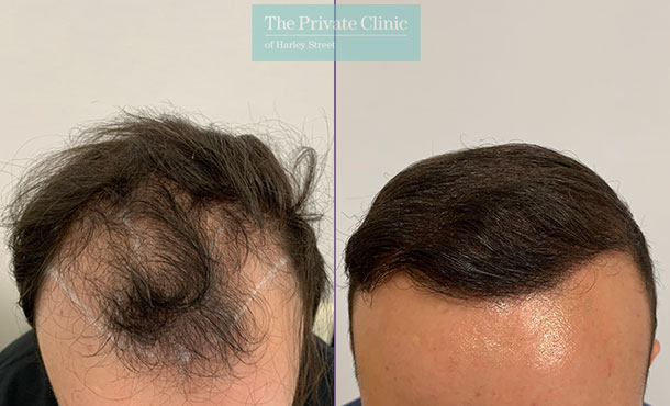 FUE Hair Transplant - 017FR-Front