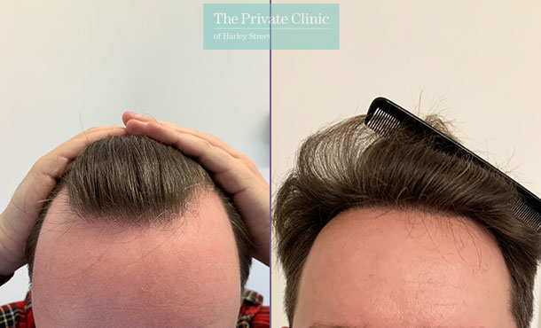 FUE Hair Transplant - 019FR-Front