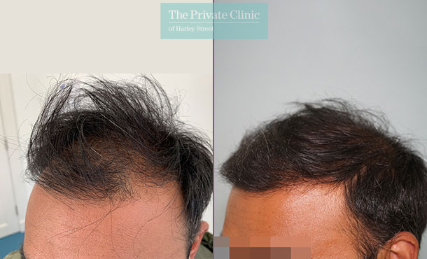 FUE Hair Transplant - 010FR-Side