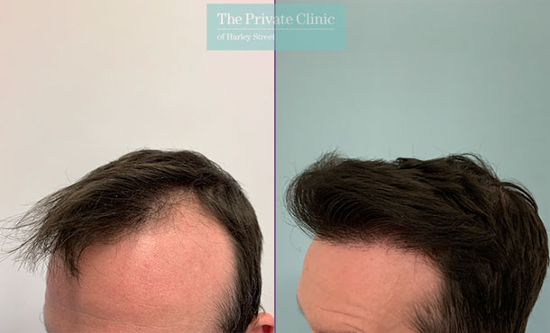 FUE Hair Transplant - 014FR-Side