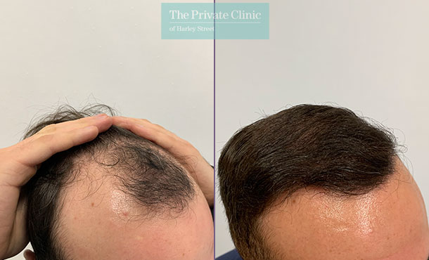 FUE Hair Transplant - 017FR-Side