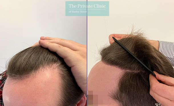 FUE Hair Transplant - 019FR-Side