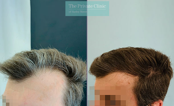 FUE Hair Transplant - 013FR-LSide