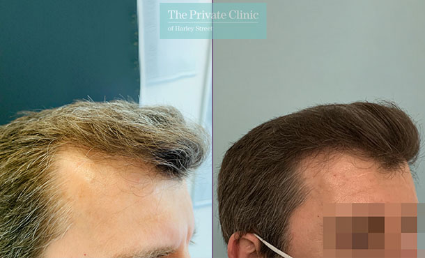 FUE Hair Transplant - 013FR-RSide