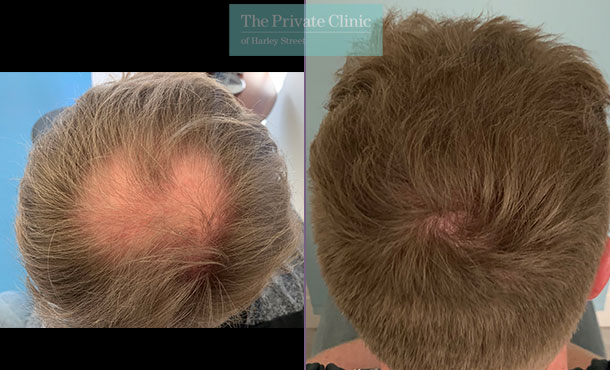 FUE Hair Transplant - 016FR