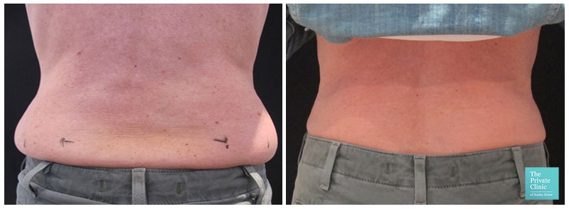 CoolSculpting Fat Reduction uffin top before after poto