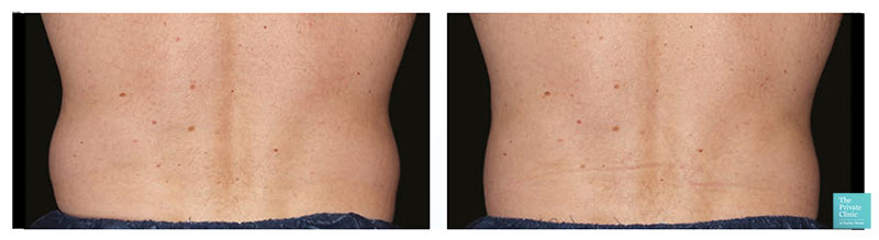 CoolSculpting Fat Reduction love handle before after photo