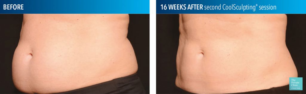 CoolSculpting Fat Reduction belly fat before after photo