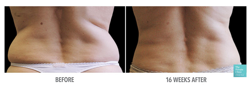 CoolSculpting Fat Reduction back before after photo