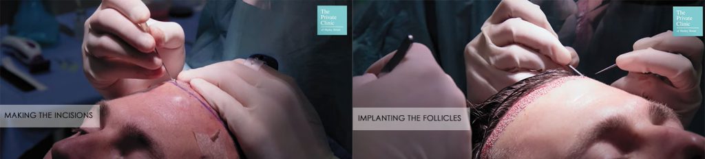 Direct hair implantation vs FUE, Hair Transplant methods, procedures and  techniques