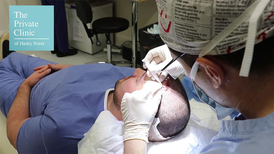 hair transplant surgeon performing FUE Hair Transplant Surgery with Implanter tool