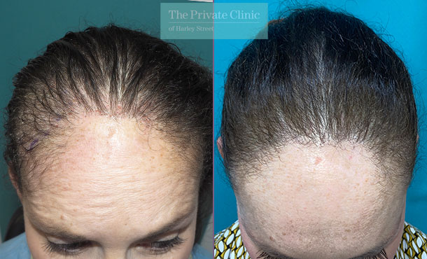 Hair Transplant for Women - Before & After Images - The Private Clinic of  Harley Street