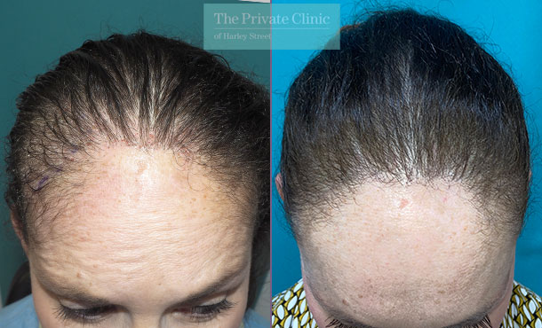 FUE Hair Transplant - Female - 030MM-Front