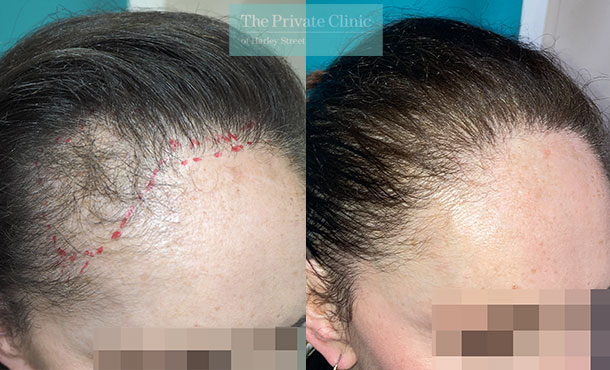 Hair Transplant for Women - Before & After Images - The Private Clinic of  Harley Street