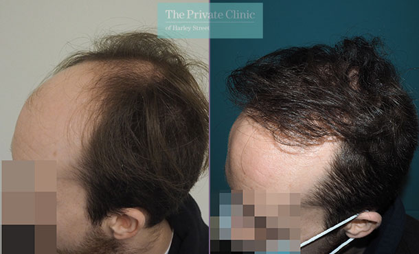FUE Hair Transplant - 029MM-Side - The Private Clinic of Harley Street
