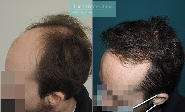 FUE Hair Transplant - 029MM-Side