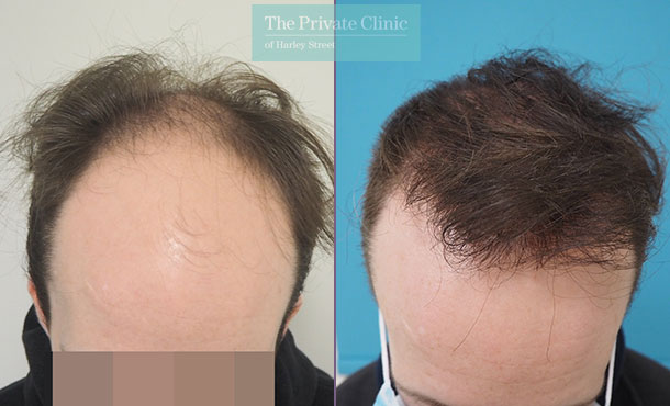 FUE Hair Transplant - 029MM-Front