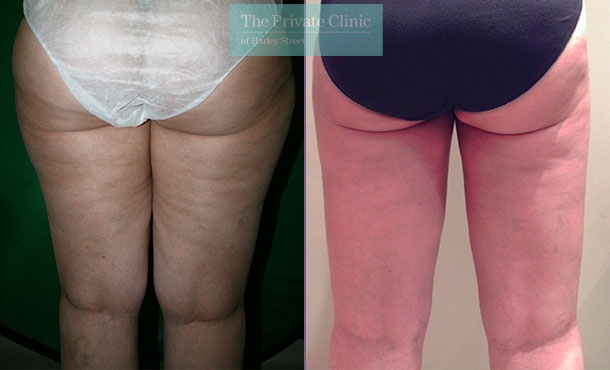 vaser liposuction on the inner thighs before and after photos