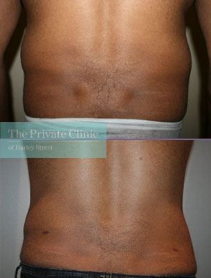 vaser liposuction on the flanks before and after photo results