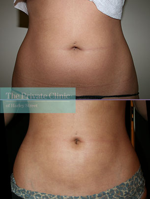 vaser liposuction on the tummy before and after photo results