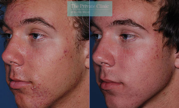 Acne obagi clenziderm products before and after photos results