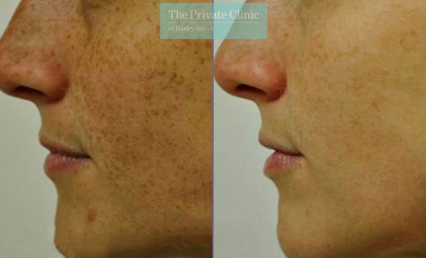 IPL photorejuvenation best treatment for pigmentation before after photo uk