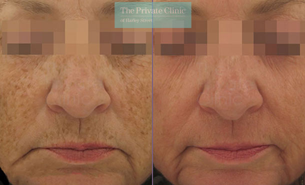 laser skin resurfacing for pigmentation before and after photos showing results