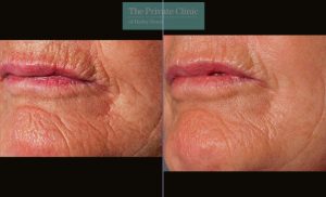 Laser resurfacing pearl smoker lines before after photo uk