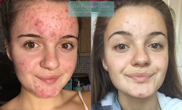 NLite laser treatment for acne before after photo