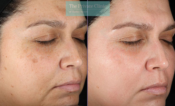 Obagi NuDerm pigmentation results uk before after photo