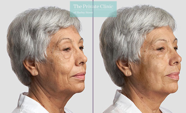 Threadlift mid face lift jawline treatment sagging skin before after photo