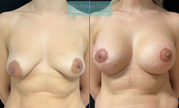 Before and after photos of breast uplift with implants