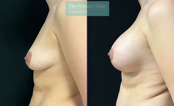 Breast Lift with Implants - 003MF-Side