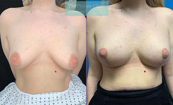 Breast Lift with Implants - 002MF-Front