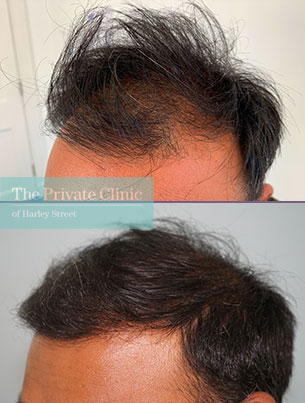 FUE Hair Transplant temples before and after photo