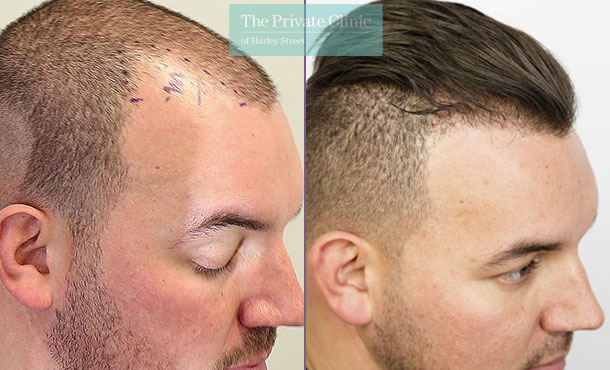 hair transplant temples before and after patient story