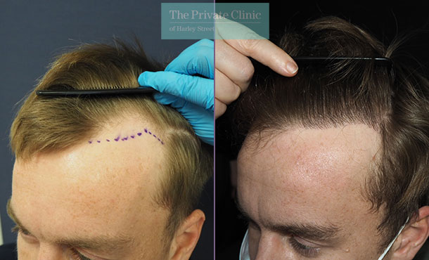 Hair Transplants for Receding Temples cost, hair transplant temples before  and after
