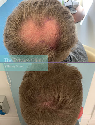 Hair Transplant crown area before and after, crown hair transplant cost uk