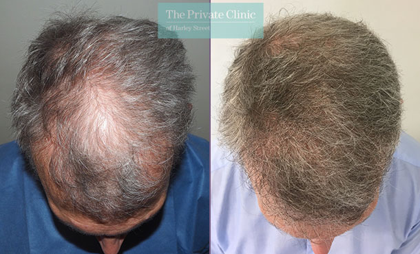 hair transplant crown area before and after uk