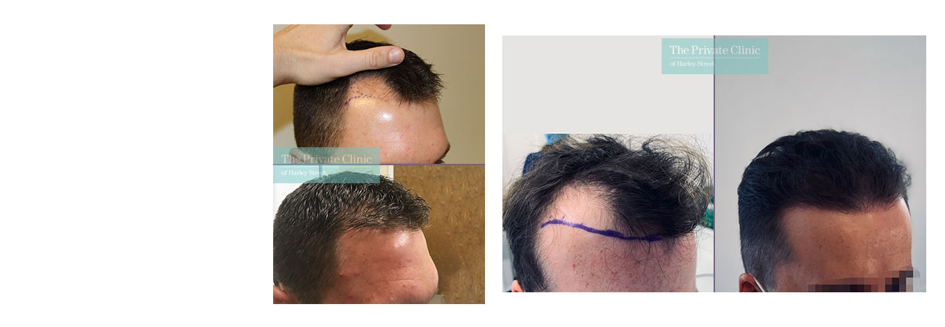 Hair Transplants for Receding Temples cost, hair transplant temples before  and after