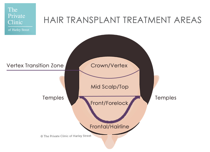 Hair Transplant Treatment Areas