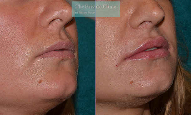 before and after photos showing results of dermal filler treatment