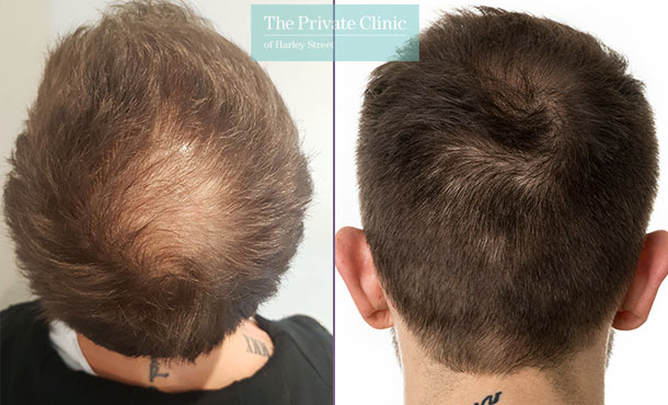 Hair Transplant crown area before and after patient story