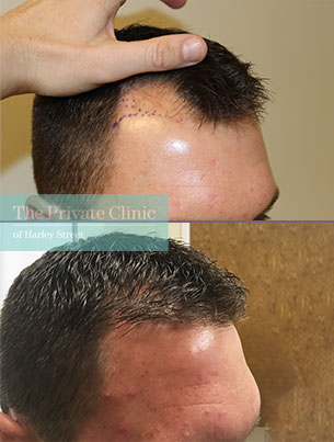 Before and after photo showing FUE Hair Transplant Results to the temples