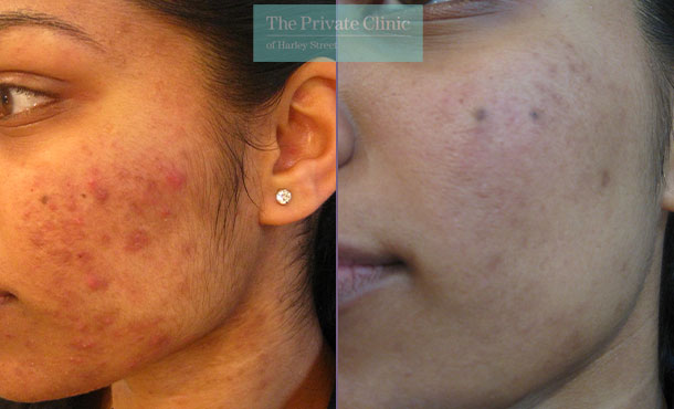 nlite before after results laser acne treatment