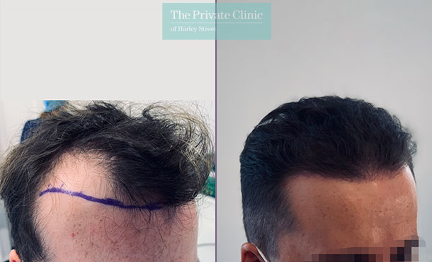 FUE Hair Transplant orocedure to the temples Before and after photo