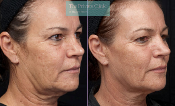 thermage skin tightening for sagging skin before after photo results