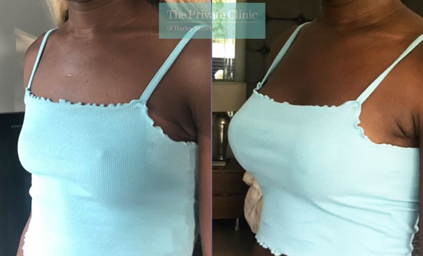 breast augmentation enlargement surgery before after results by mr adrian richards