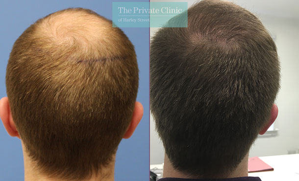 Before and after photos of FUE Hair Transplant Procedure